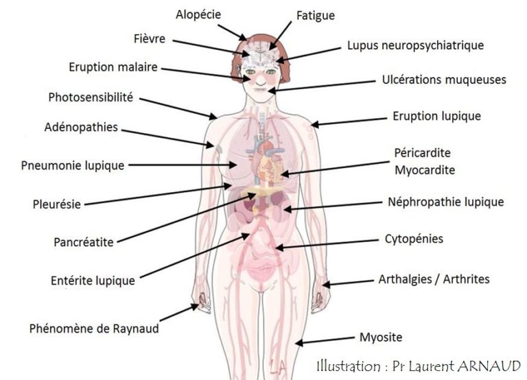 signes cliniques symptomes du lupus systémiques