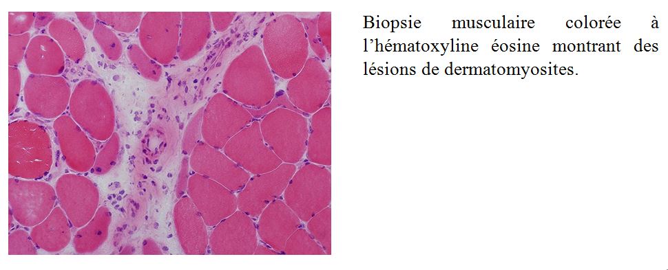 biopsie musculaire myosite