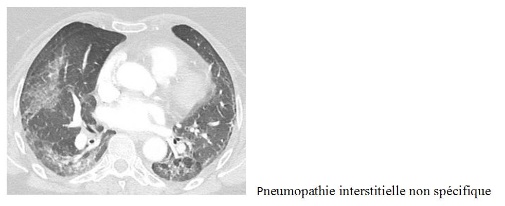 pneumopathie interstitielle poumon myosite