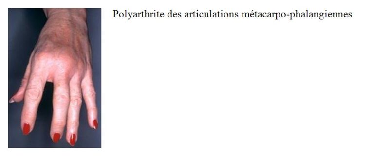 Quels sont les causes de la myosite inflammatoire chez l’enfant