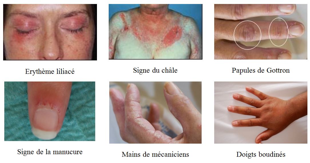Myopathies inflammatoires CRMR des maladies autoimmunes de